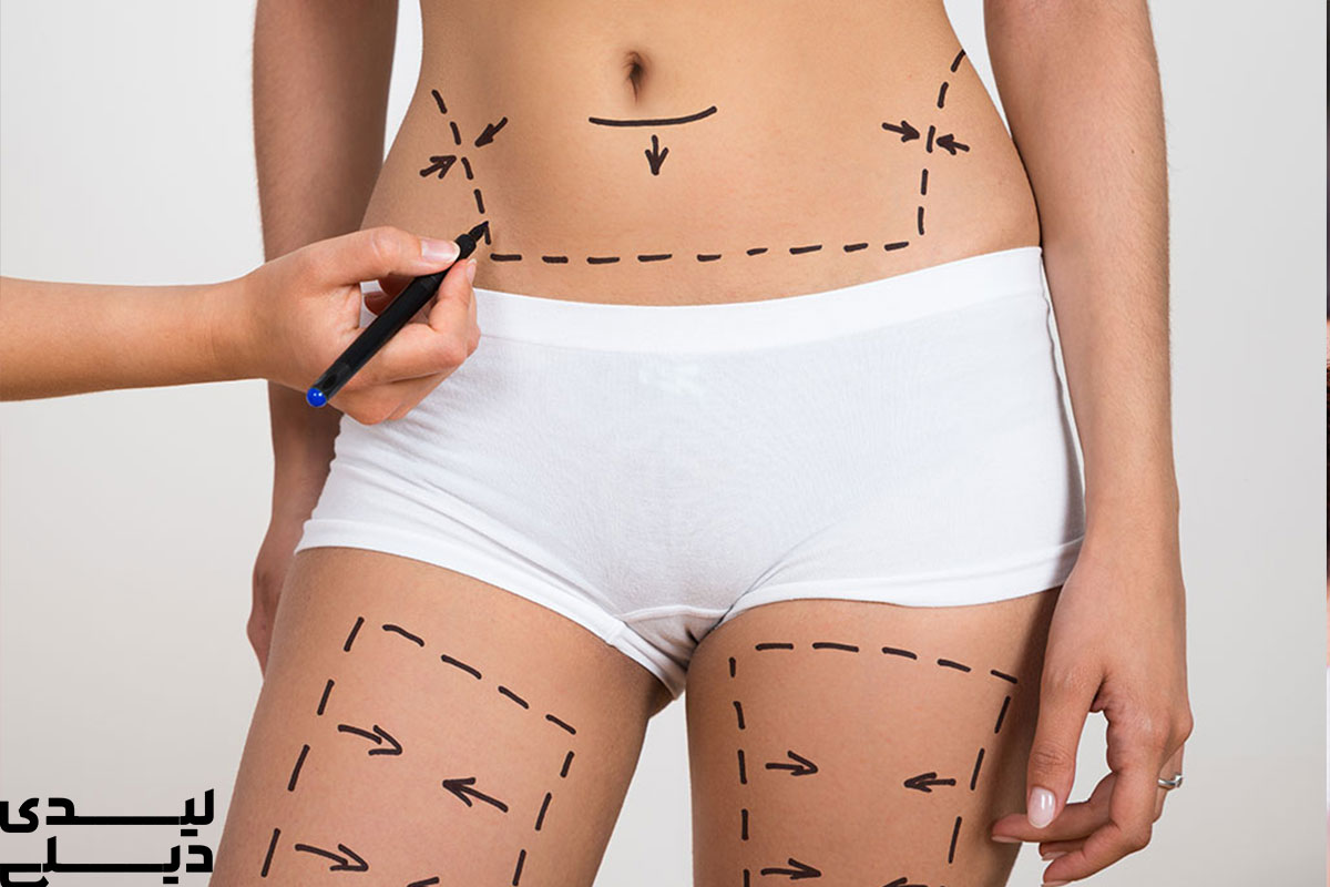 بهترین عمل زیبایی لاغری