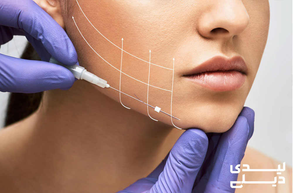 لیفت صورت با نخ