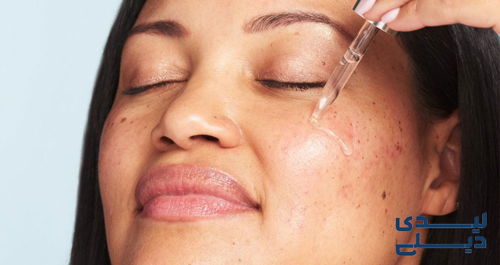 نیاسینامید برای جوش و آکنه